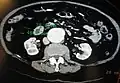 A transverse contrast enhanced CT scan demonstrating an abdominal aortic aneurysm of 4.8 by 3.8 cm