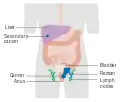 Stage 4 anal cancer